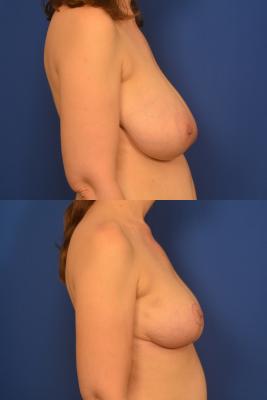 Breast Reduction