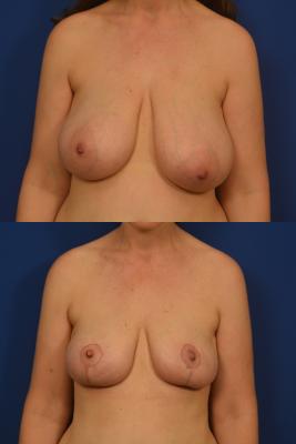 Breast Reduction