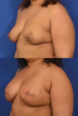 Breast Reconstruction