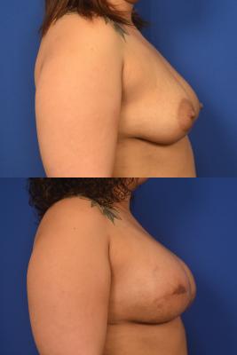 Breast Reconstruction