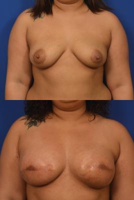 Breast Reconstruction