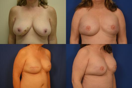 Breast Reconstruction 