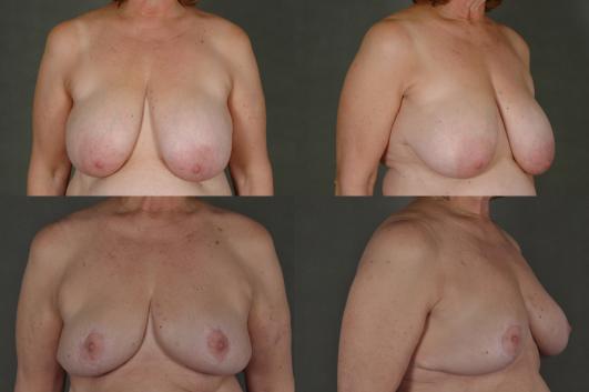 Breast Reduction 