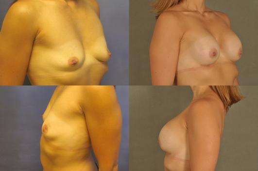 Breast Augmentation