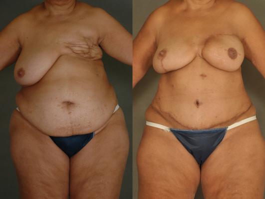 DIEP FlapBreast Reconstruction