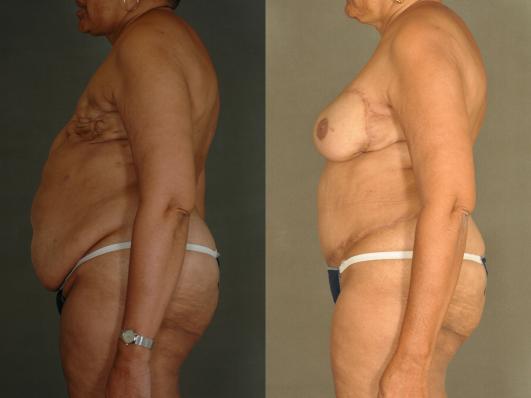 DIEP FlapBreast Reconstruction