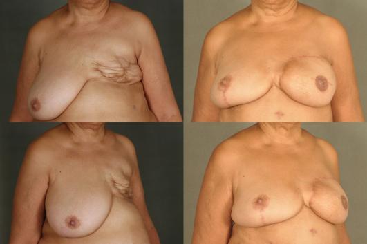 DIEP FlapBreast Reconstruction