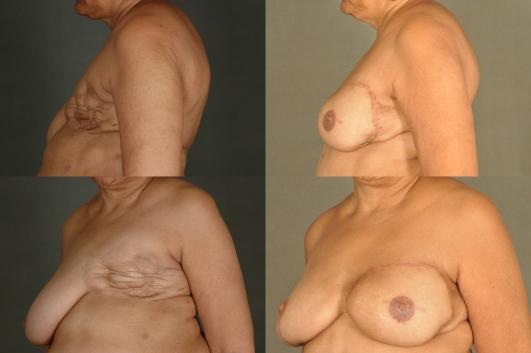 DIEP FlapBreast Reconstruction