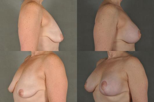 Breast Augmentation and Lift 