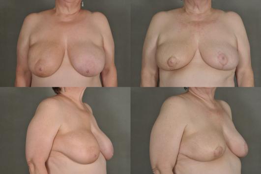 Oncoplastic Breast Reduction 