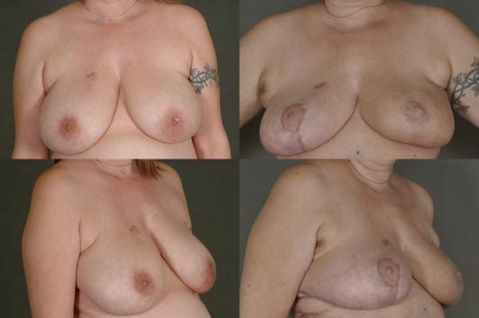 Oncoplastic Breast Reduction 