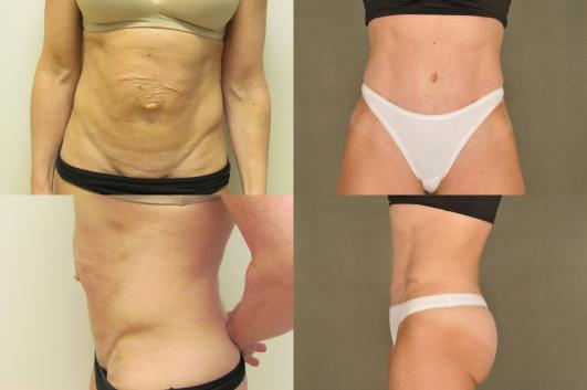 Tummy Tuck