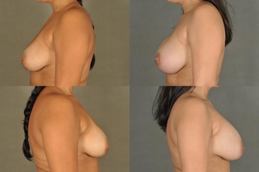 Breast Augmentation 