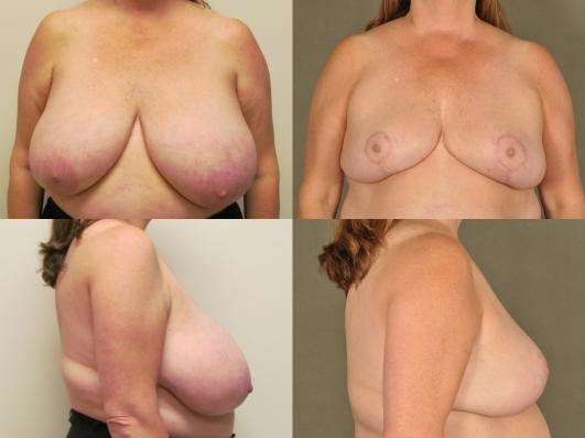 Breast Reduction