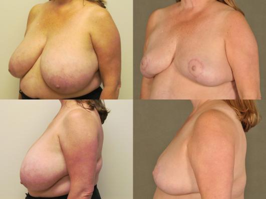 Breast Reduction