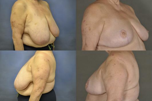 Breast Reduction