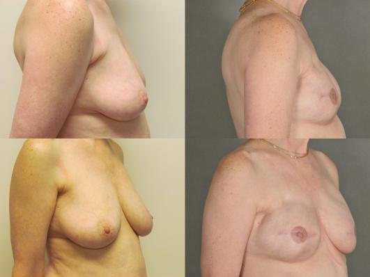 Patient in her 40s with preexisting L breast scar,who underwent bilateral skin sparing mastectomy and implant reconstruction