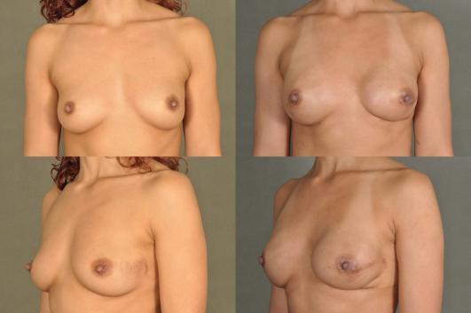 Breast Reconstruction Implants
