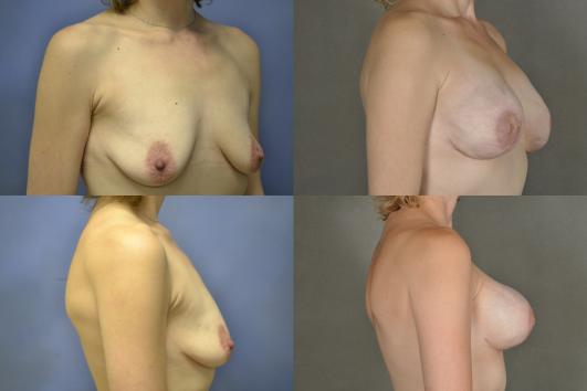 Nipple sparing implant reconstruction