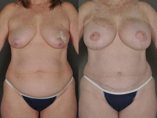 bilateral mastectomy and DIEP flap reconstruction