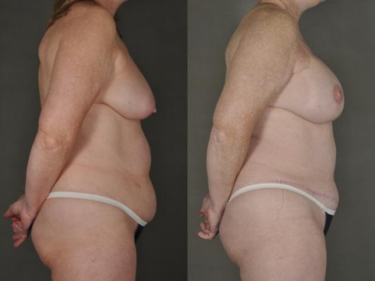 bilateral mastectomy and DIEP flap reconstruction