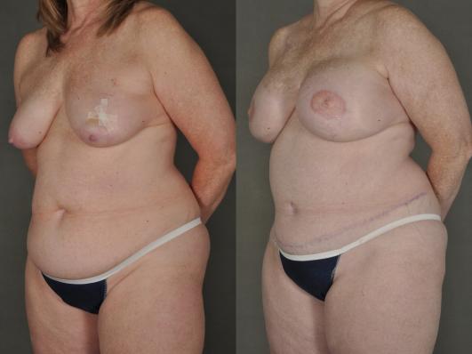 bilateral mastectomy and DIEP flap reconstruction