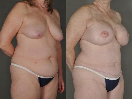 bilateral mastectomy and DIEP flap reconstruction