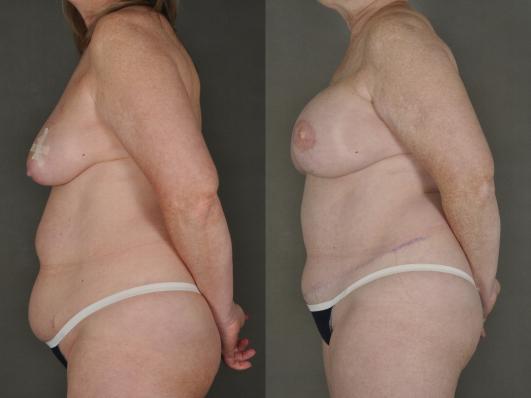 bilateral mastectomy and DIEP flap reconstruction