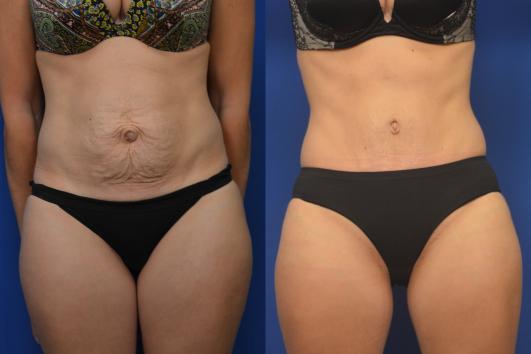 Tummy Tuck