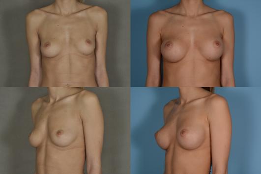 Breast Augmentation with Saline Implants, Exchange for Larger Implants