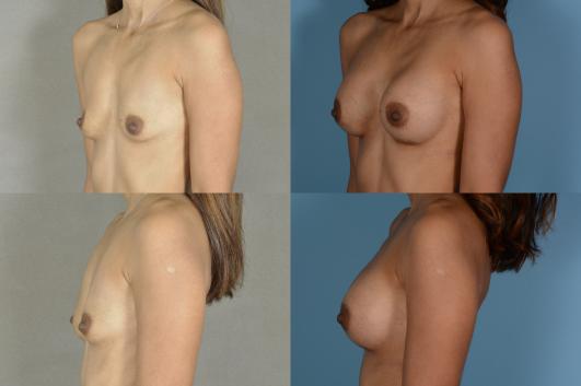 Breast Augmentation 