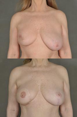 TRAM Flap Breast Reconstruction