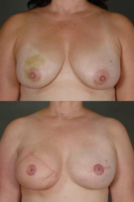 TRAM flap breast reconstruction