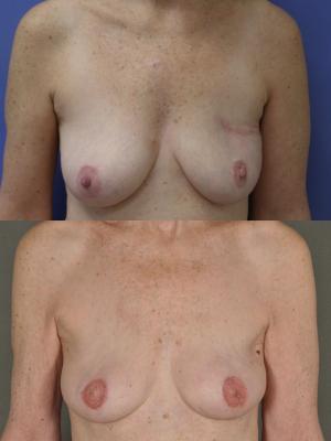 TRAM flap breast reconstruction