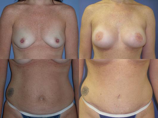 TRAM flap breast reconstruction