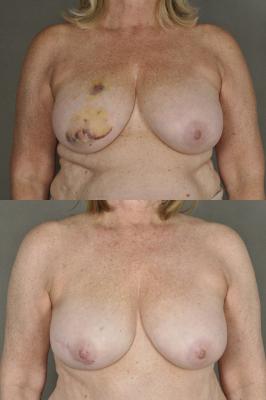 TRAM Flap Breast Reconstruction