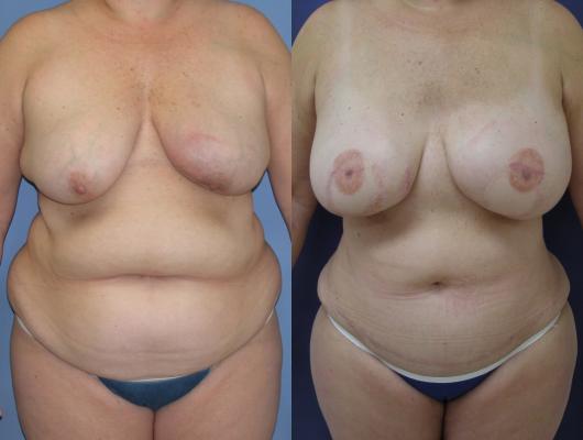 TRAM Flap Breast Reconstruction 