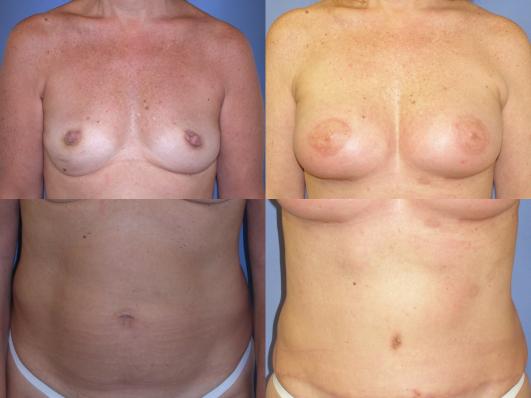 TRAM flap breast reconstruction