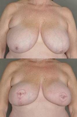 TRAM flap breast reconstruction