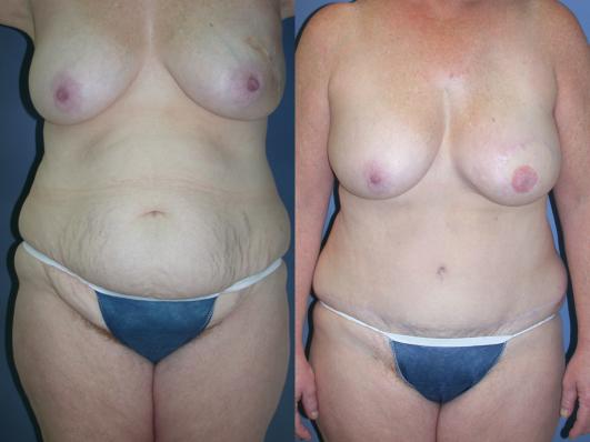 TRAM flap breast reconstruction