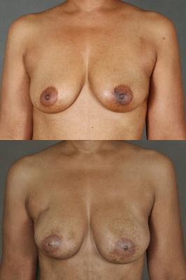 TRAM flap breast reconstruction