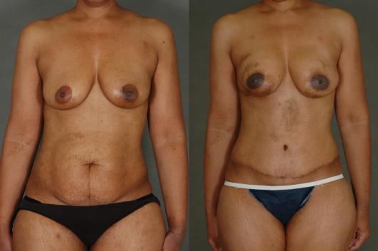 TRAM flap breast reconstruction