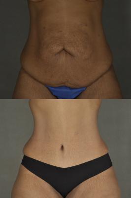 Tummy tuck and arm lift