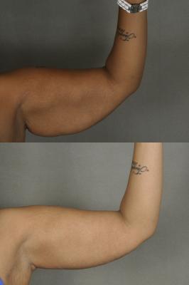 Tummy tuck and arm lift