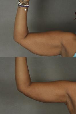 Tummy tuck and arm lift