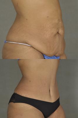 Tummy tuck and arm lift