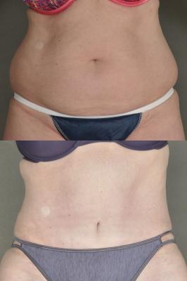 Tummy tuck and liposuction