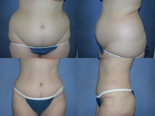 Tummy tuck and liposuction