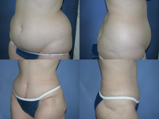 Tummy tuck and liposuction