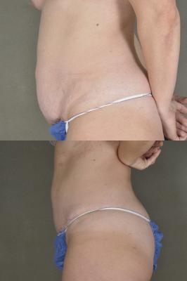 Tummy tuck and liposuction surgery